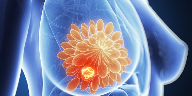 6 Fakta Mengejutkan Tentang Risiko Kanker Payudara