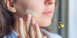 Skincare yang Mengandung Bahan Alami dan Ampuh Atasi Bekas Jerawat